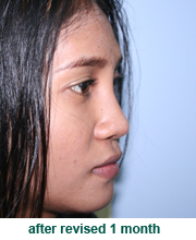 plastic_surgery_augmentation_rhinoplasty